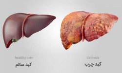 کاهش چربی شکم کلید مقابله با کبد چرب است